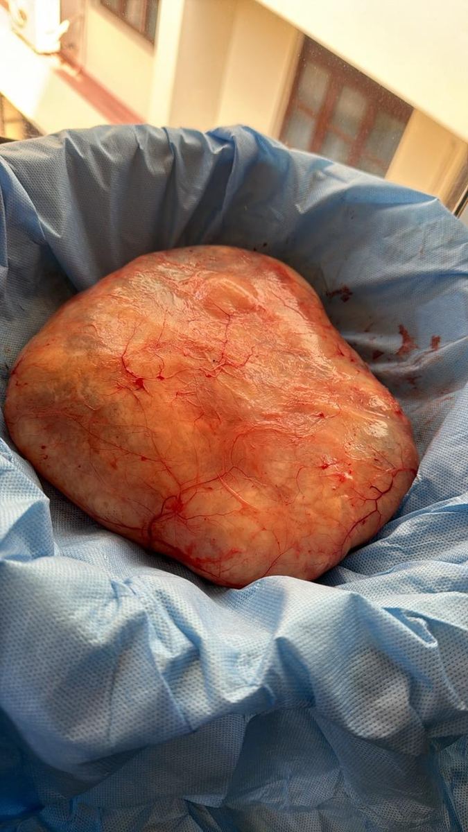 Excised surgical specimen on surgical drape