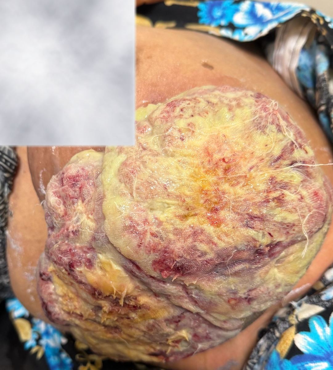 Large tumour mass — surgical case