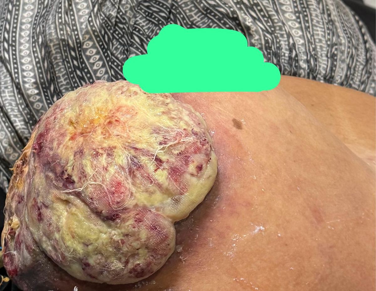 Breast tumour with skin puckering — clinical case